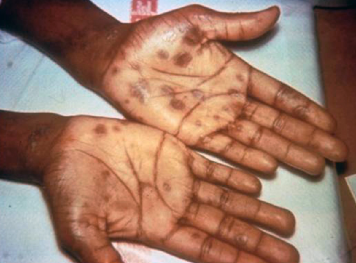 Red marks on hands